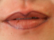 リップライン施術直後。口角がくっきりします。１週間後は本来の唇のお色より少し濃い朱赤になります。