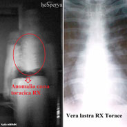 6 - Confronto anomalia cassa toracica con vero RX torace