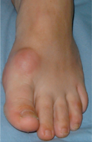 Hallux rigidus chaussures best sale