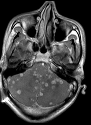 Neurocysticercosis multifocal contrast enhanced