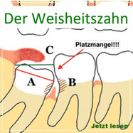 Weisheitszahn