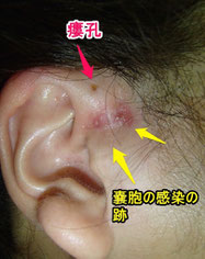 先天性耳瘻孔