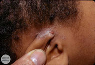 Eczéma sur peau noire de couleur grise derrière l'oreille d'un enfant