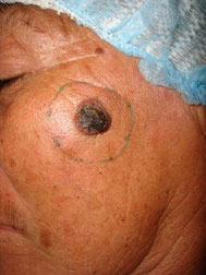 cirugía de tumor, tumor en cara, tumor maligno, tumor benigno