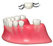 部分入れ歯