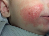 Eczéma atopique de la joue d'un bébé