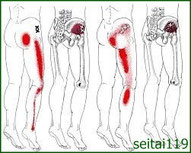 股関節の痛み,トリガーポイント