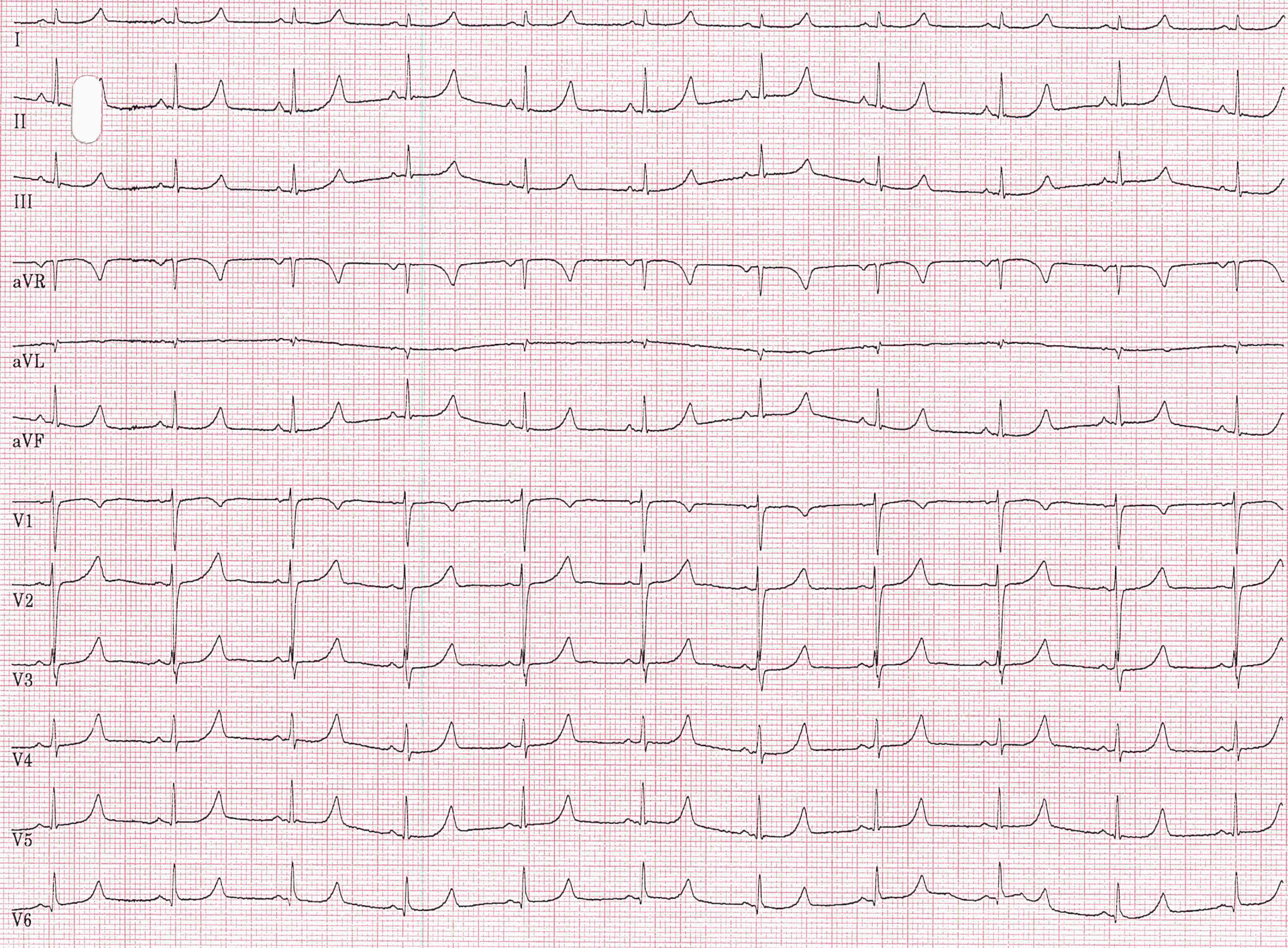 Long Qt Syndrom Fokus Ekg