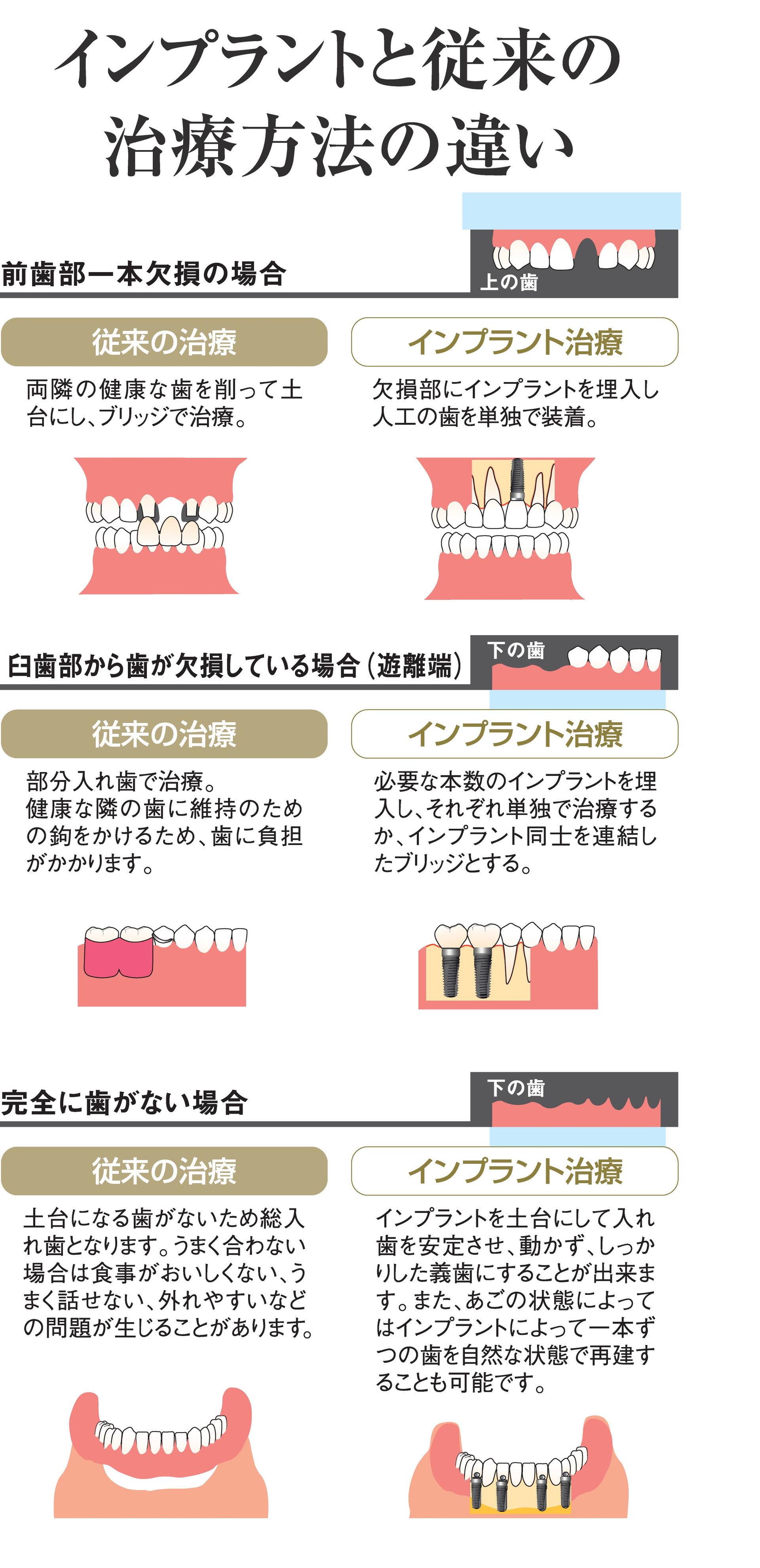 インプラント 並木町歯科診療所 秦野市並木町の歯医者 インプラント 並木町歯科診療所 秦野市並木町の歯医者