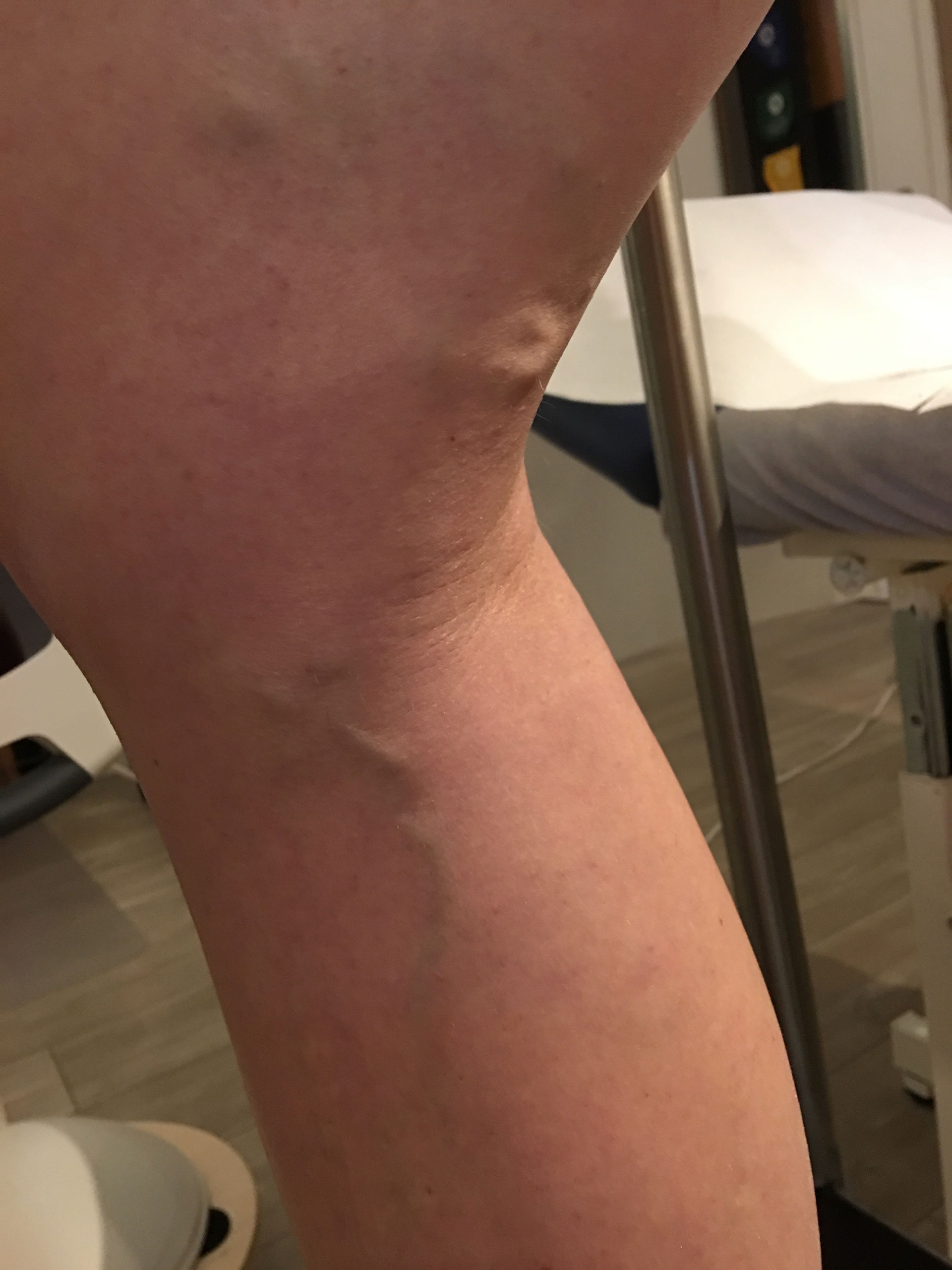 VorherNachher Krampfadern schonend entfernen nach Dr. Sundaro Köster