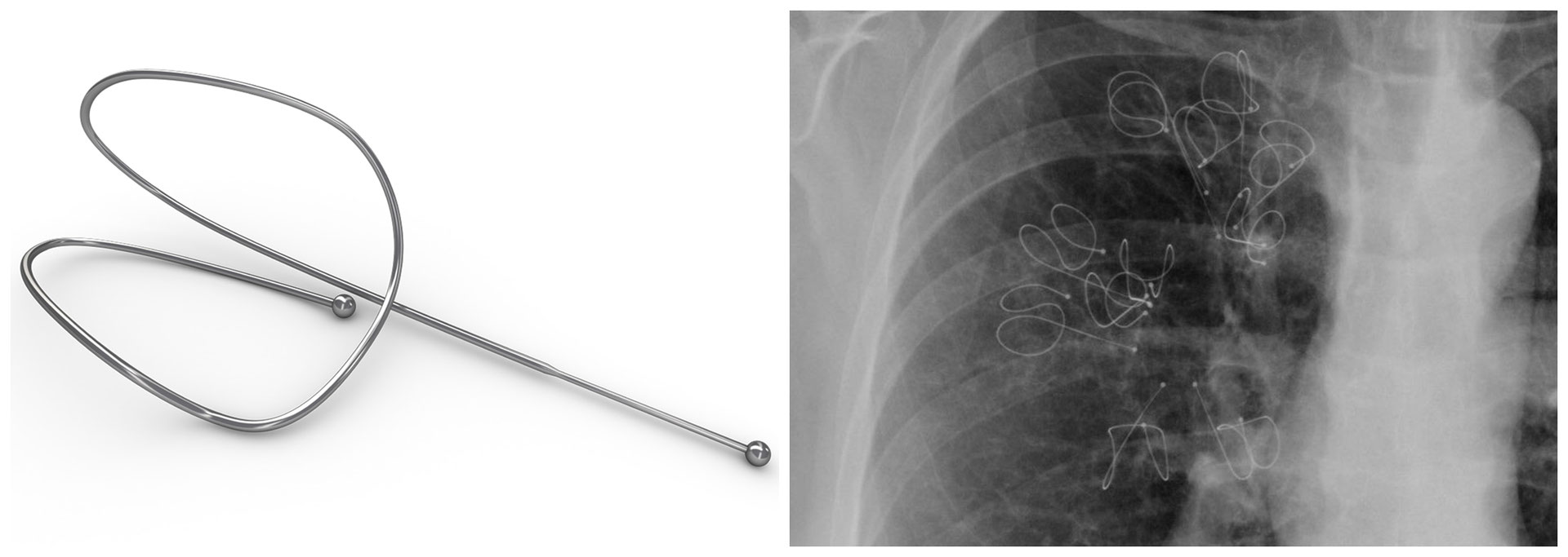 Behandeling met coils De website van bronchoscopieumcg!