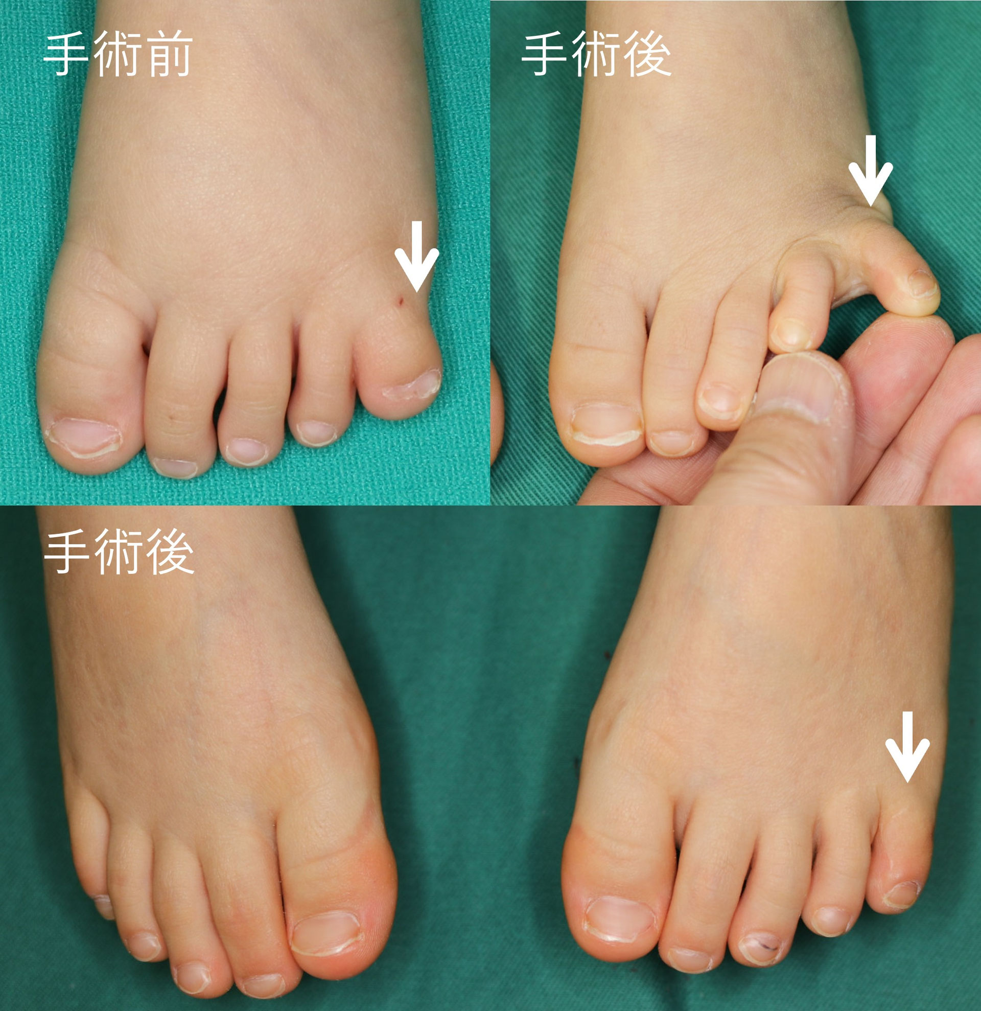 足の多指症や合指症について - 手の小児形成外科医 齊藤晋のホームページ