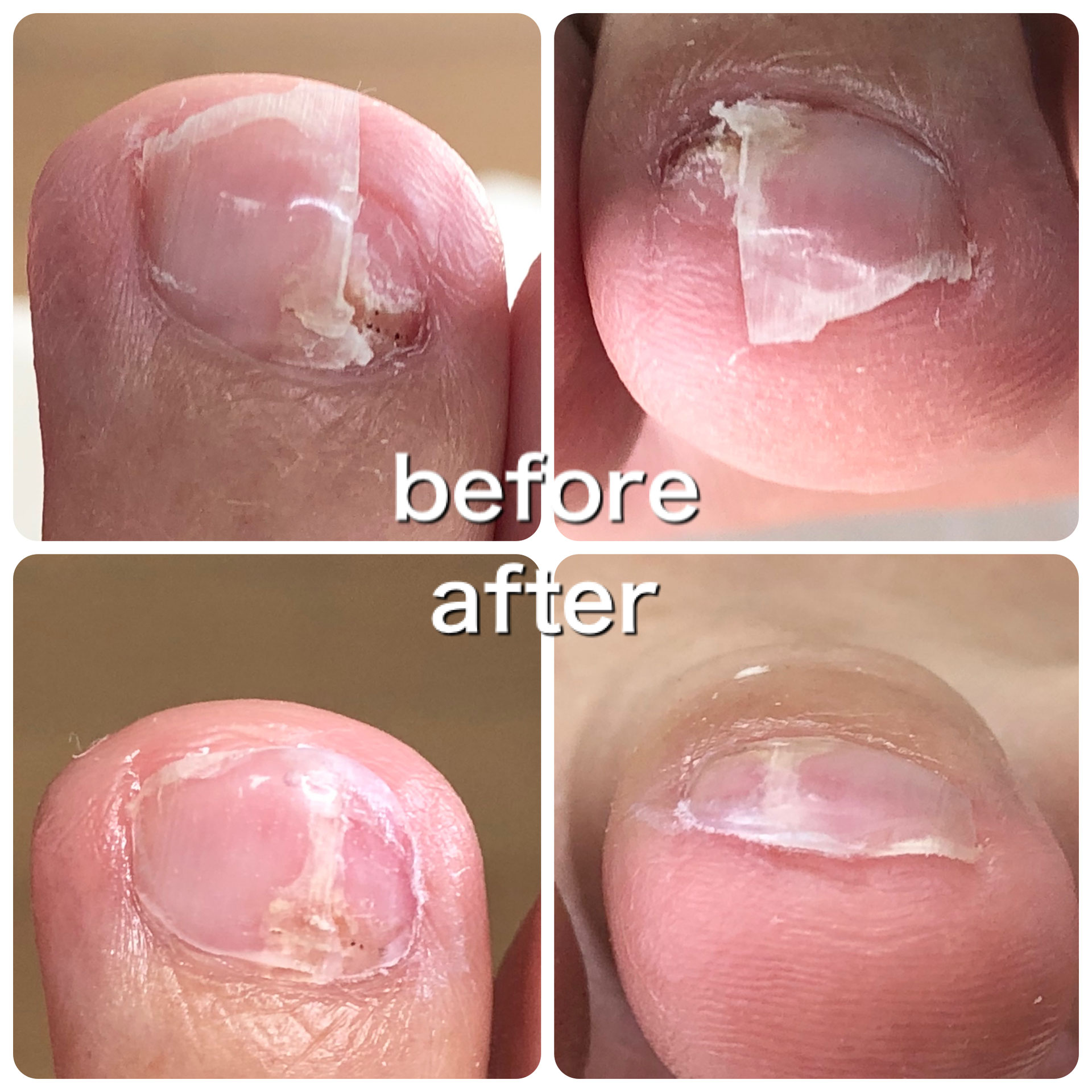 割れて無くなった爪も元通りに 一般社団法人東京フットケア協会