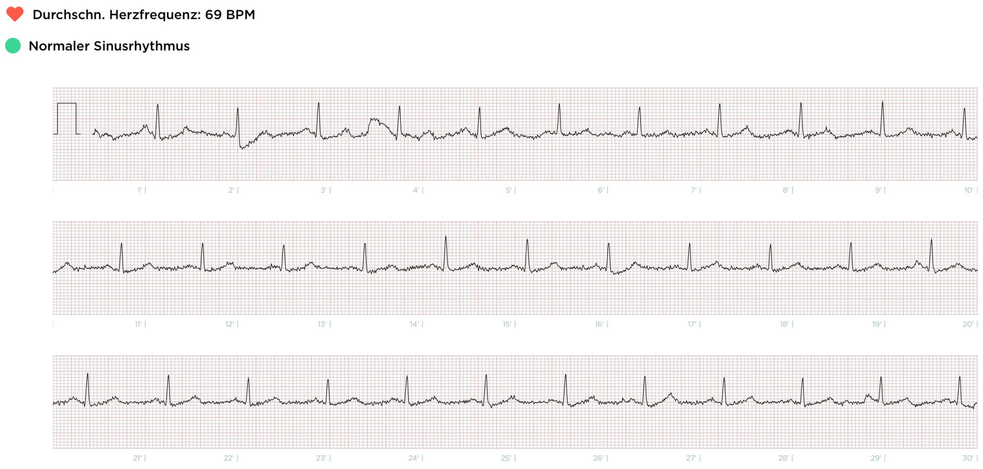 SmartwatchEKG FokusEKG