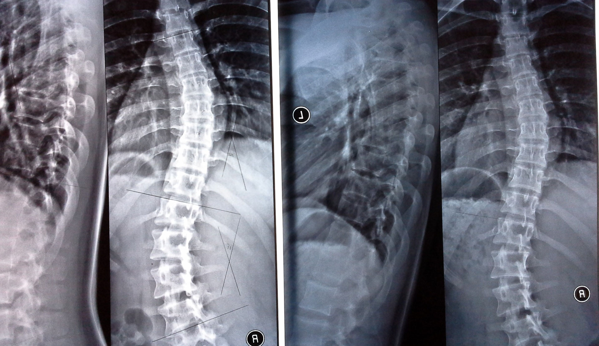 側わん症 - 大阪本町の整体・院長が米国国家資格者「ドクター
