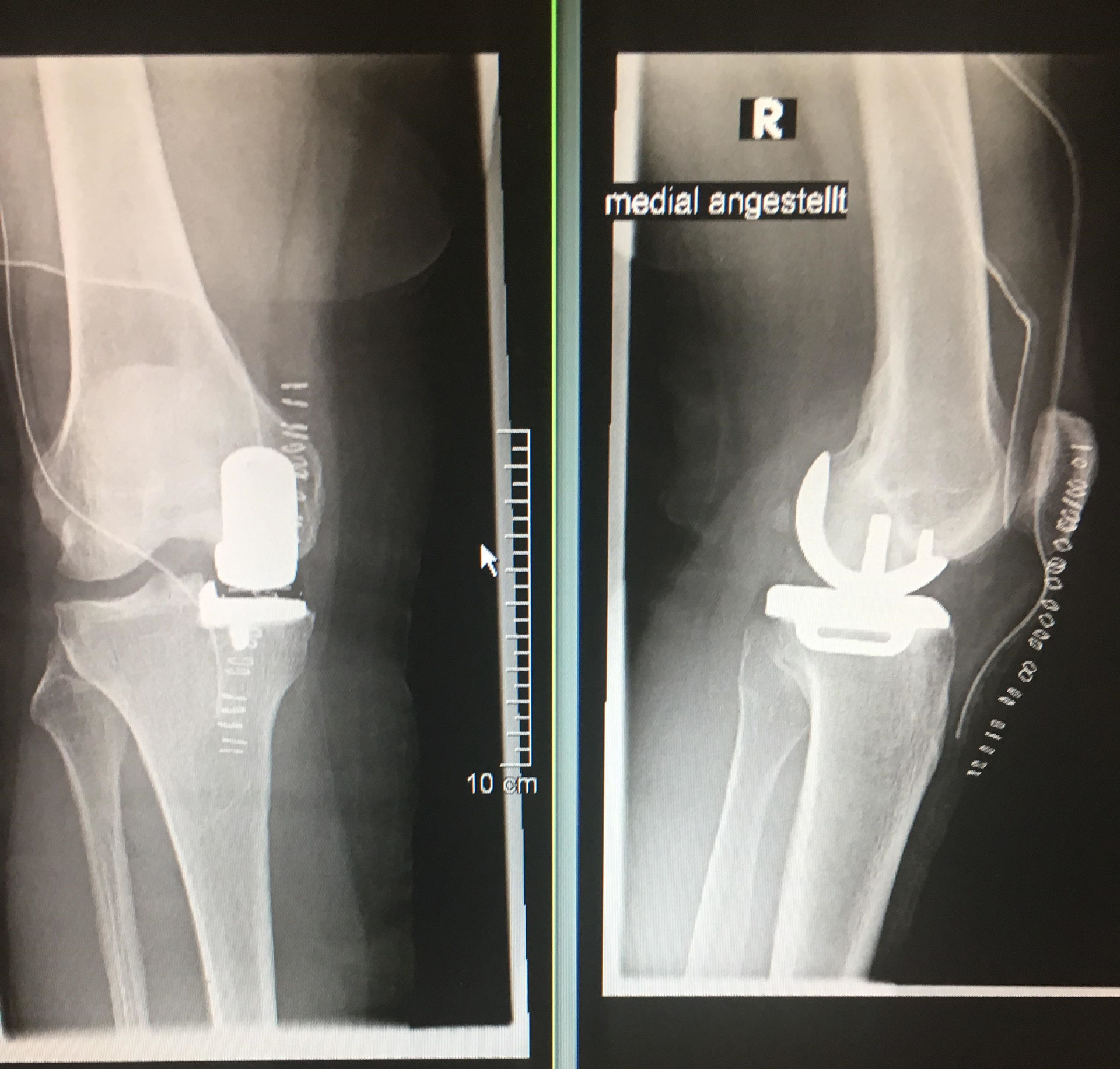 Das künstliche Kniegelenk - orthopaedieateihs Webseite!