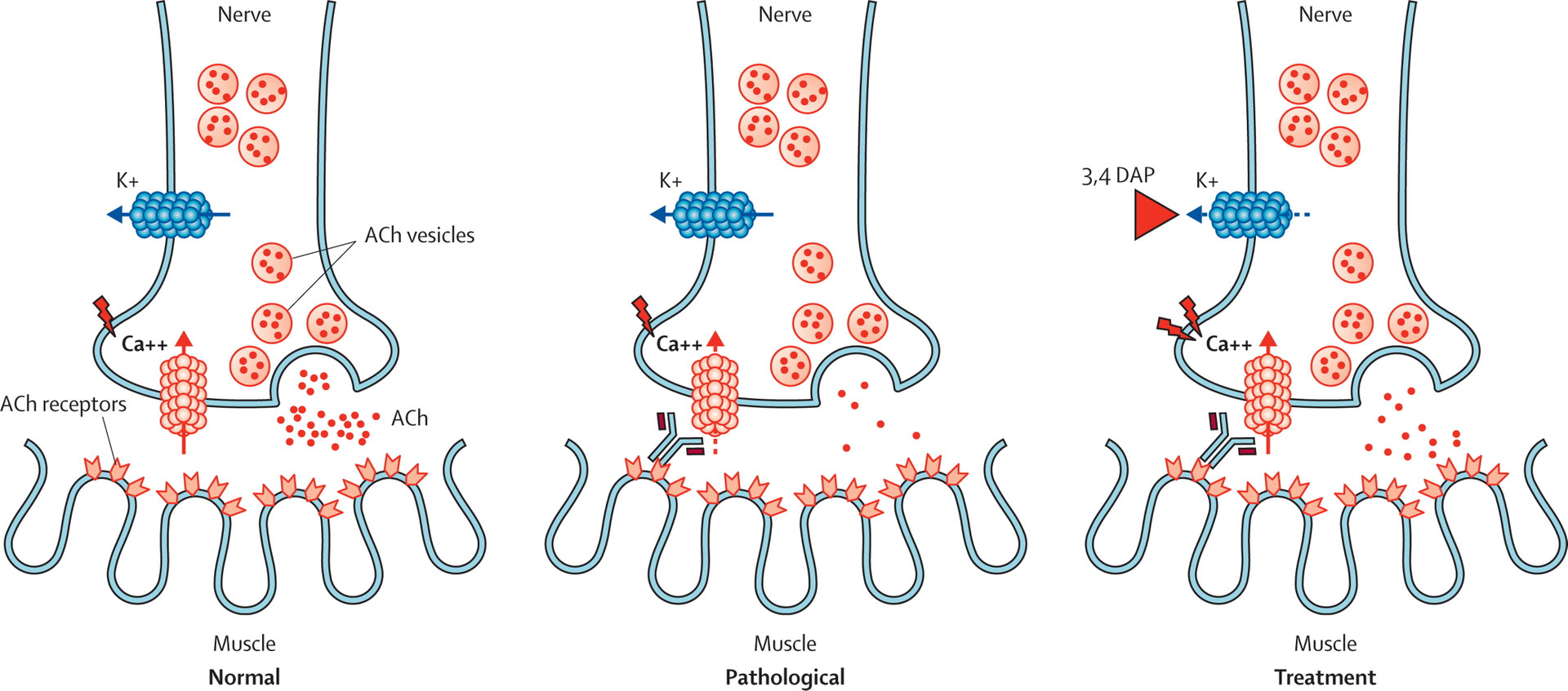 Lambert–Eaton myasthenic syndrome - NeurologyNeeds.com