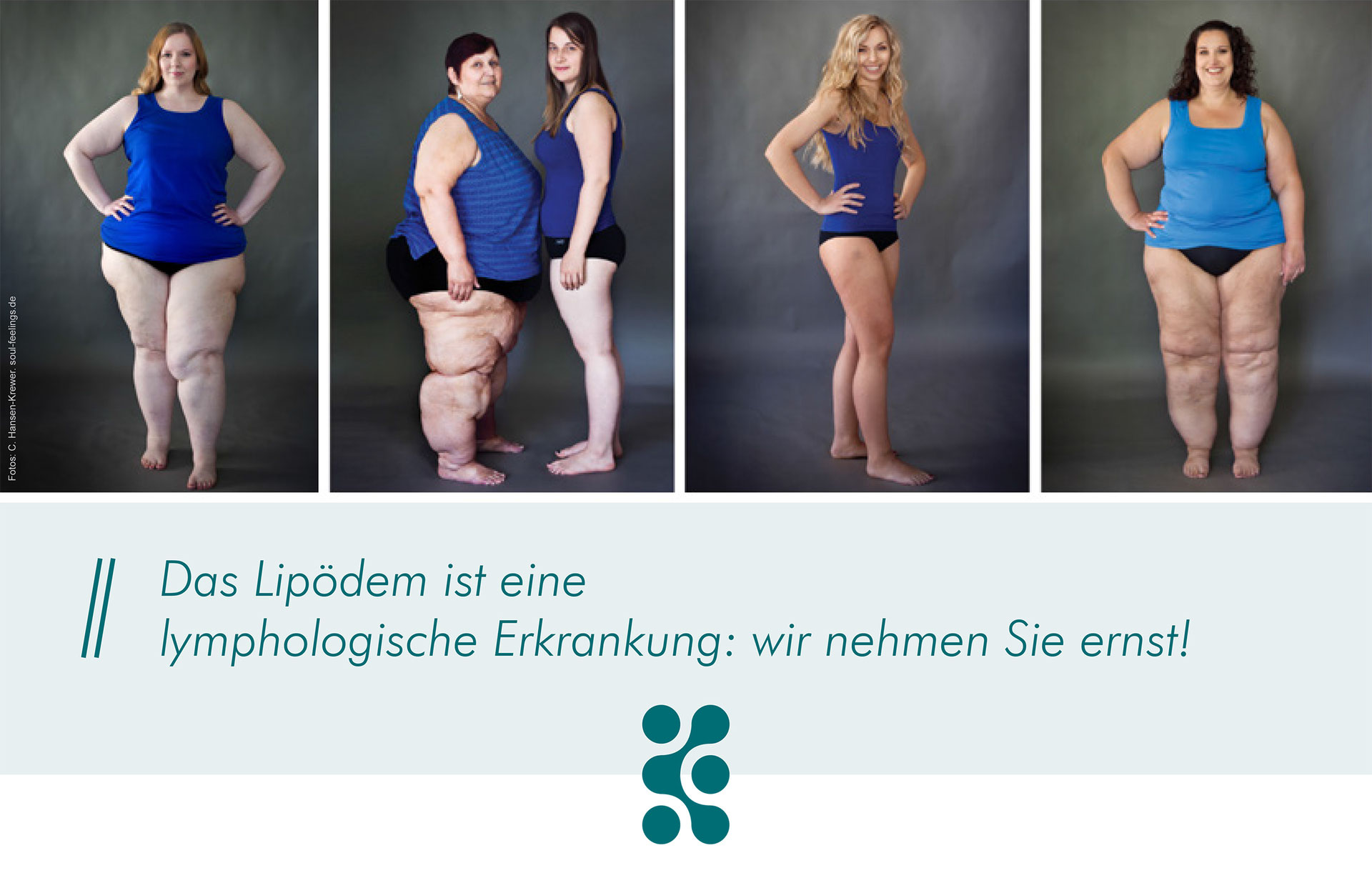 Lipödem CG Lympha Fachklinik für Operative Lymphologie. Therapie der