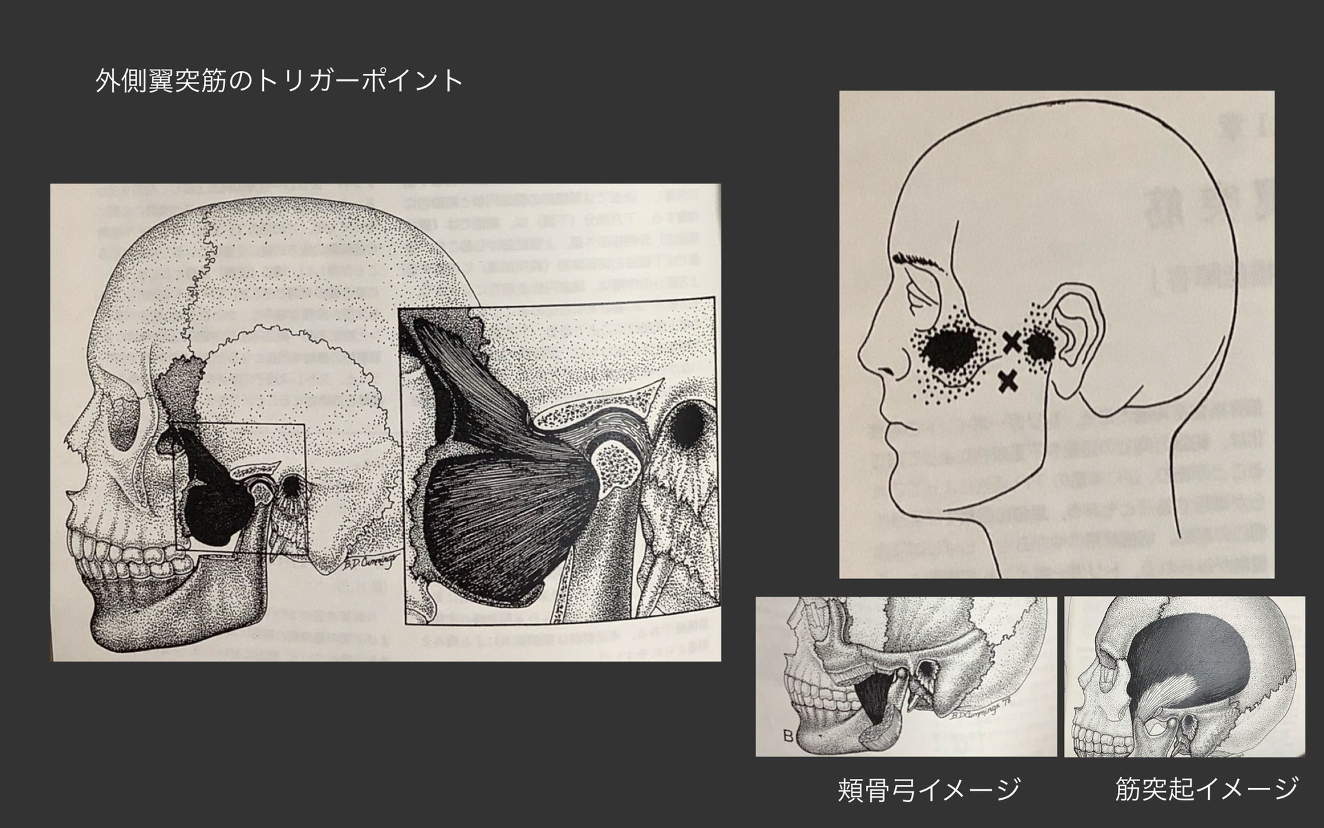 顎関節症の治療について - Higuchi鍼灸院
