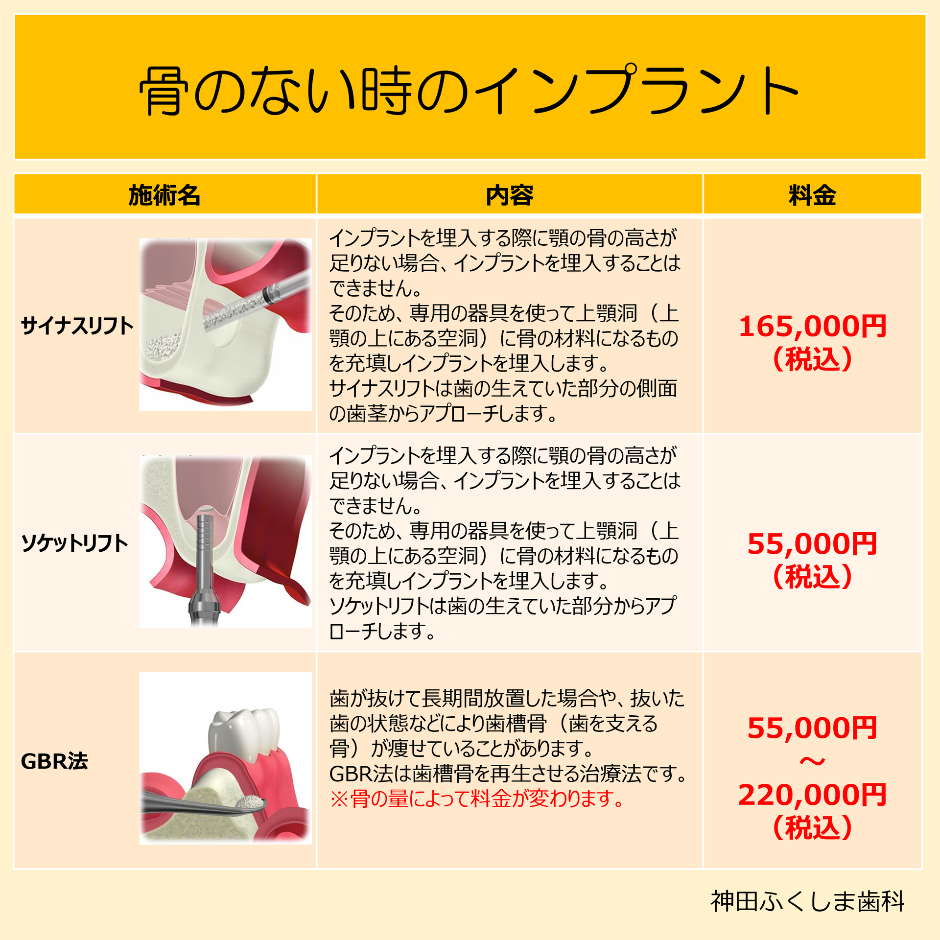 骨が無い時の増骨について - 神田ふくしま歯科