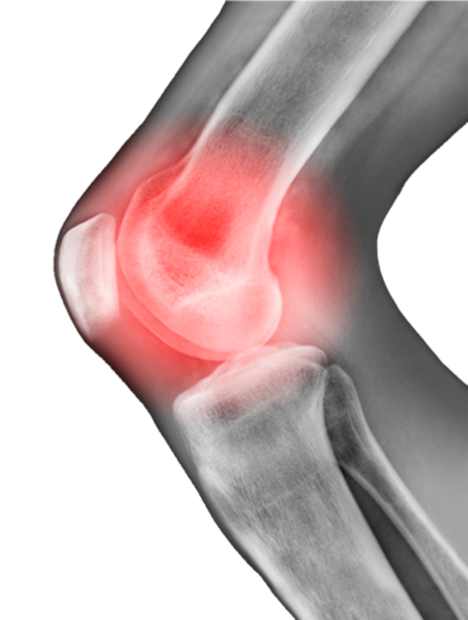 “Knee Sleeve” may help elderly from Knee Osteoarthritis VITAL SALVEO