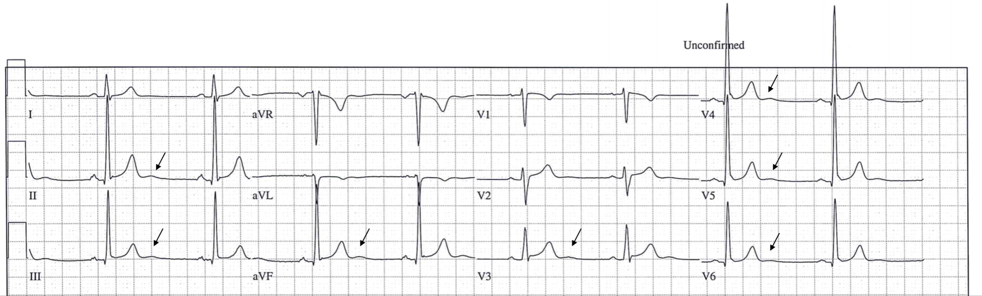 U Welle Fokus Ekg
