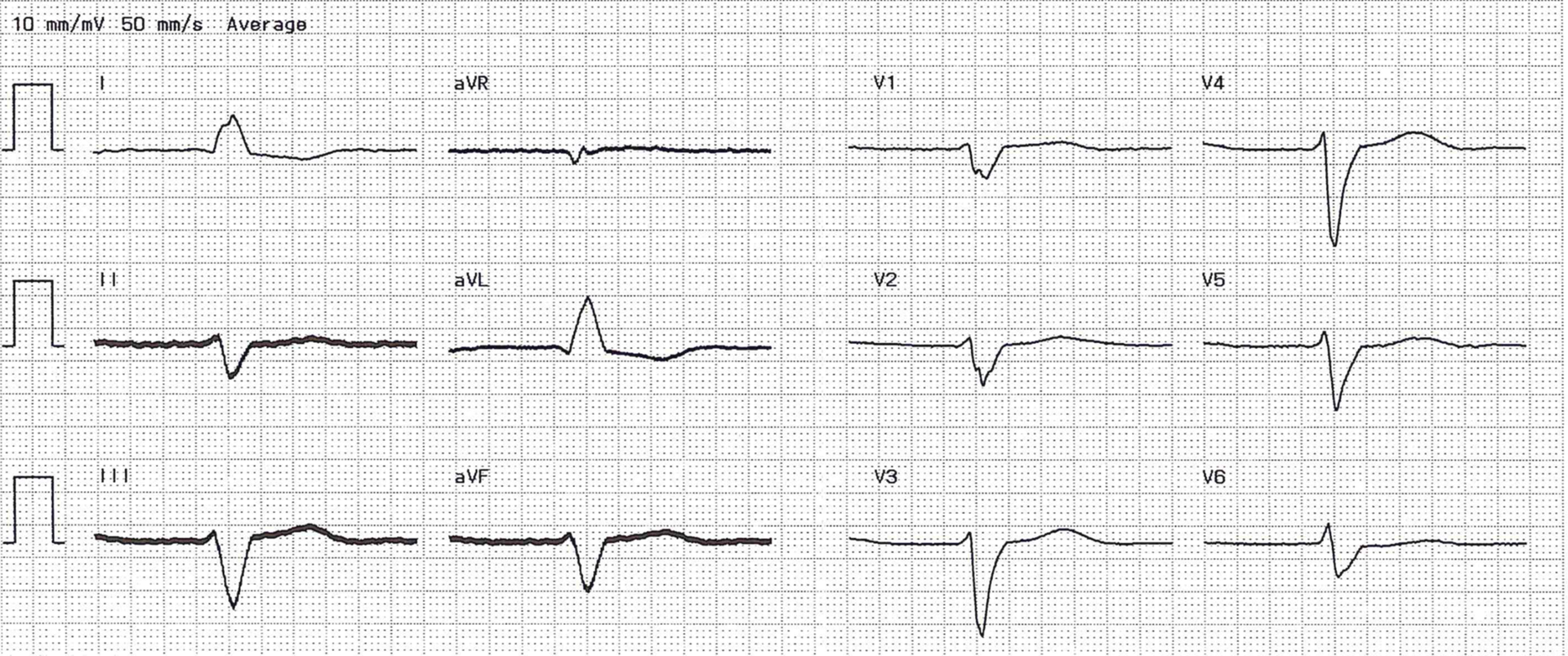 Kardiale Resynchronisationstherapie Fokus Ekg Kardiale Resynchronisationstherapie Fokus Ekg