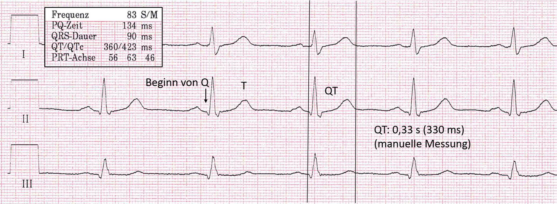 qt intervall fokus ekg
