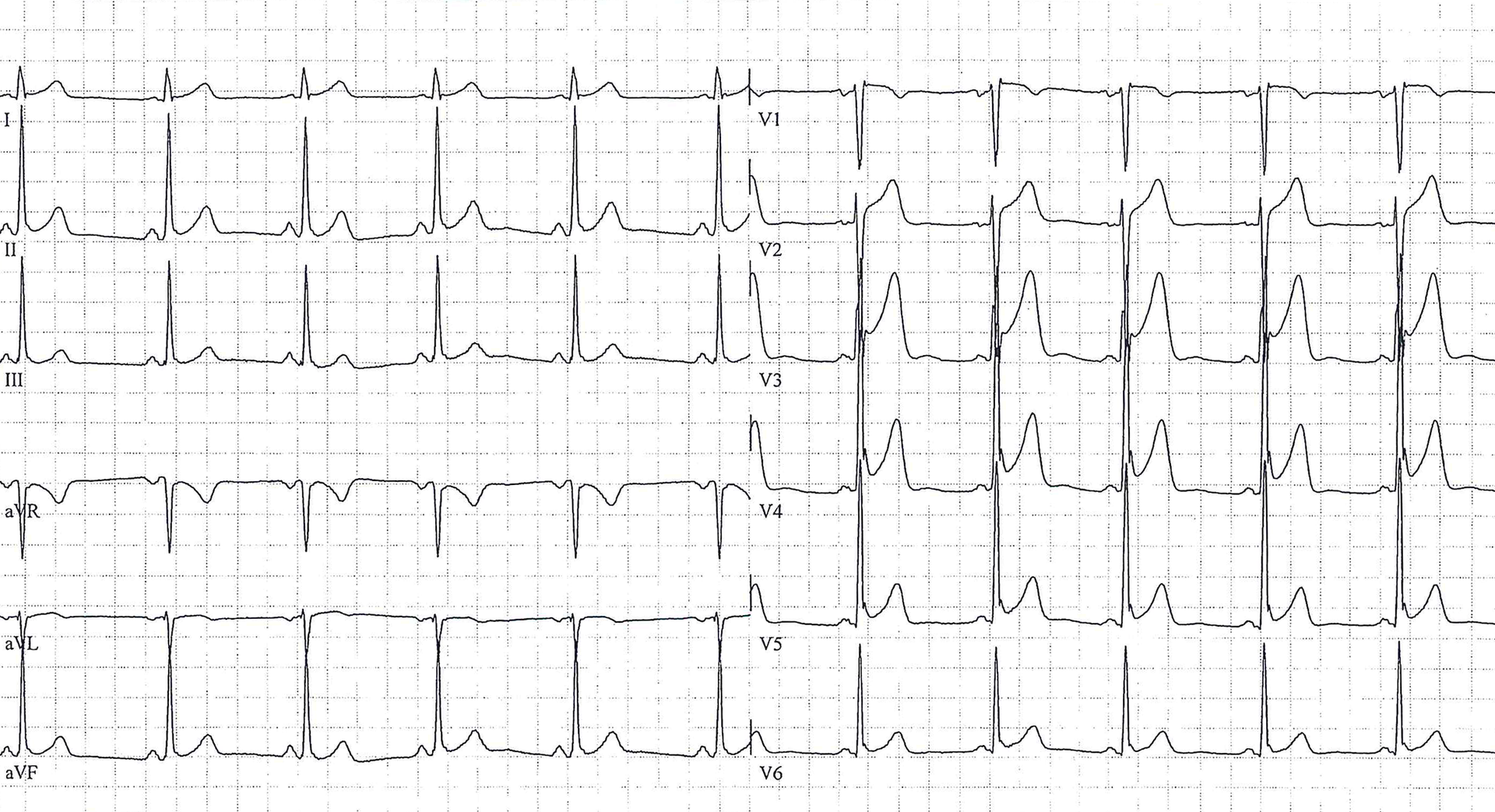 J-Punkt und J-Welle - Fokus-EKG