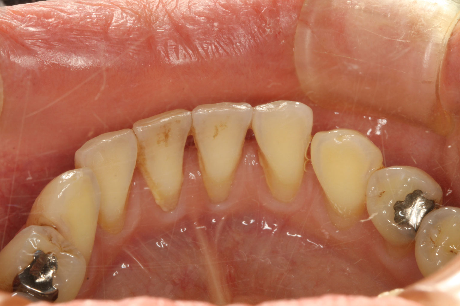 前歯 の 裏 の 歯茎