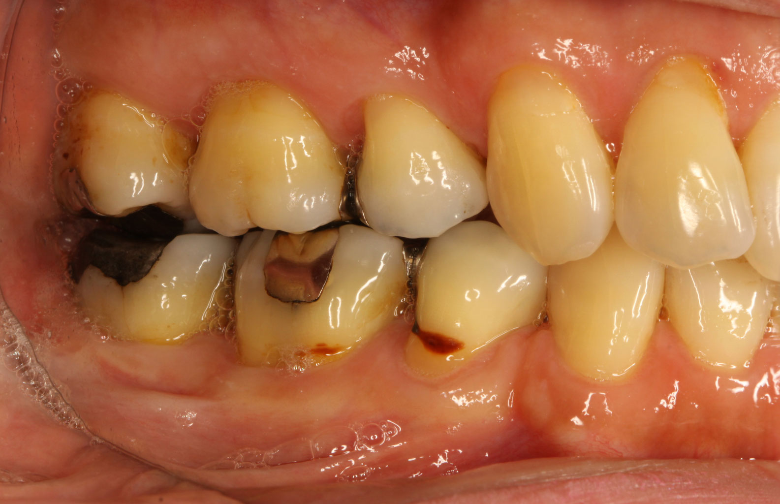 奥歯の歯茎再生 矯正後に歯茎が下がって虫歯になったケース ３４ 神田ふくしま歯科