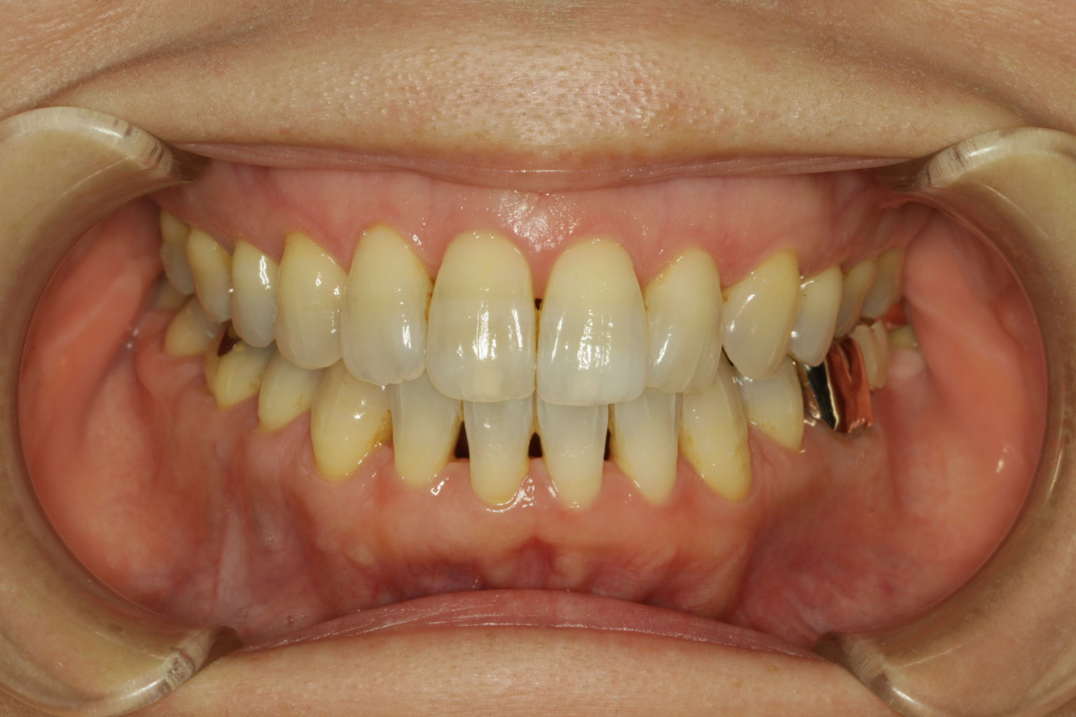 歯と歯の間の隙間を埋める治療 ダイレクトボンド法 神田ふくしま歯科