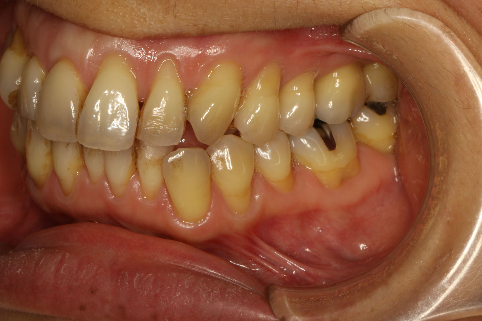 奥歯 の 歯茎