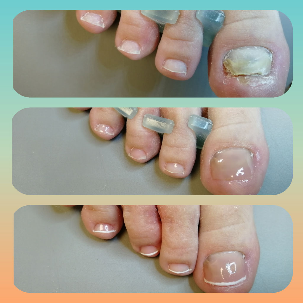 Schimmelnagel, Kalknagel Behandeling - Medisch Pedicure Zundert