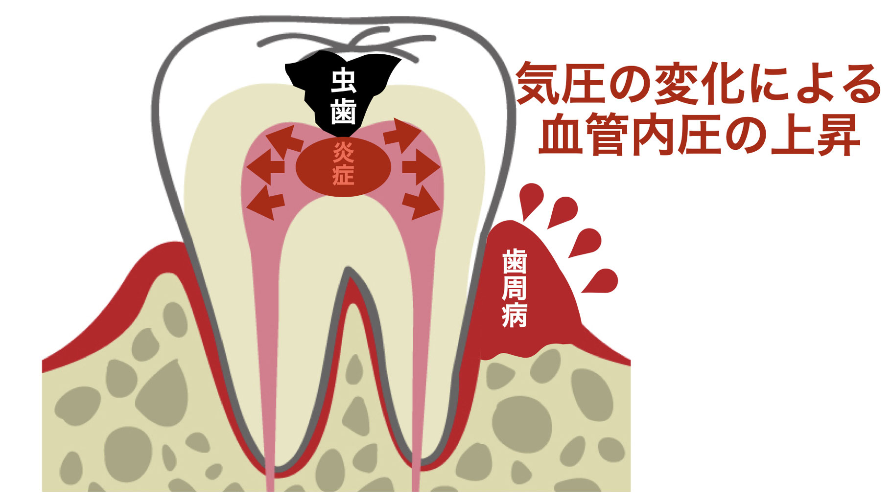 気圧と歯の痛み - てらお総合歯科クリニック