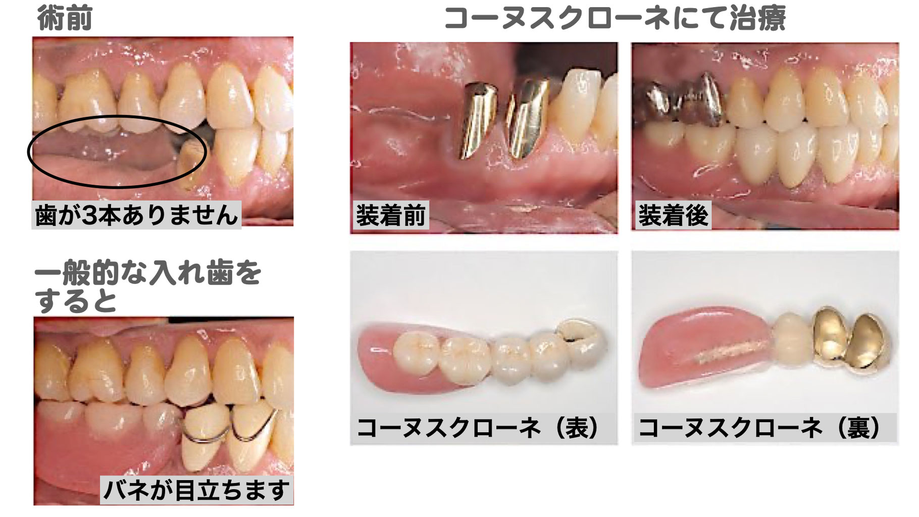くらしを楽しむアイテム 金属バネのない見た目に優れた入れ歯 てらお総合歯科クリニック - 健康・医学