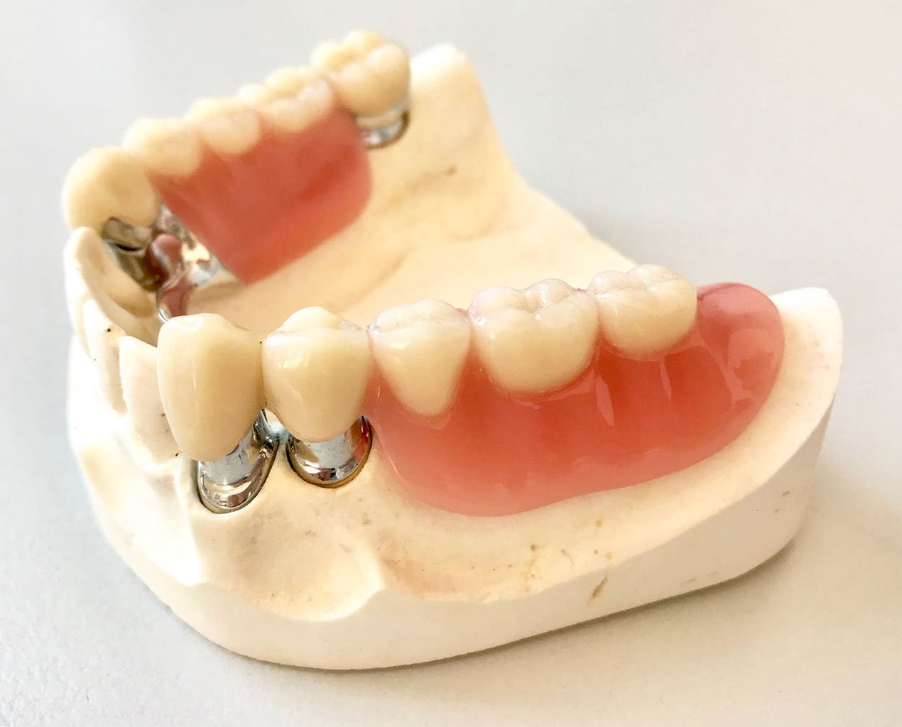 Zahnersatz Praxis Fur Zahnheilkunde Implantologie Dr Med Dent Malte Uhrigshardt In Tornesch