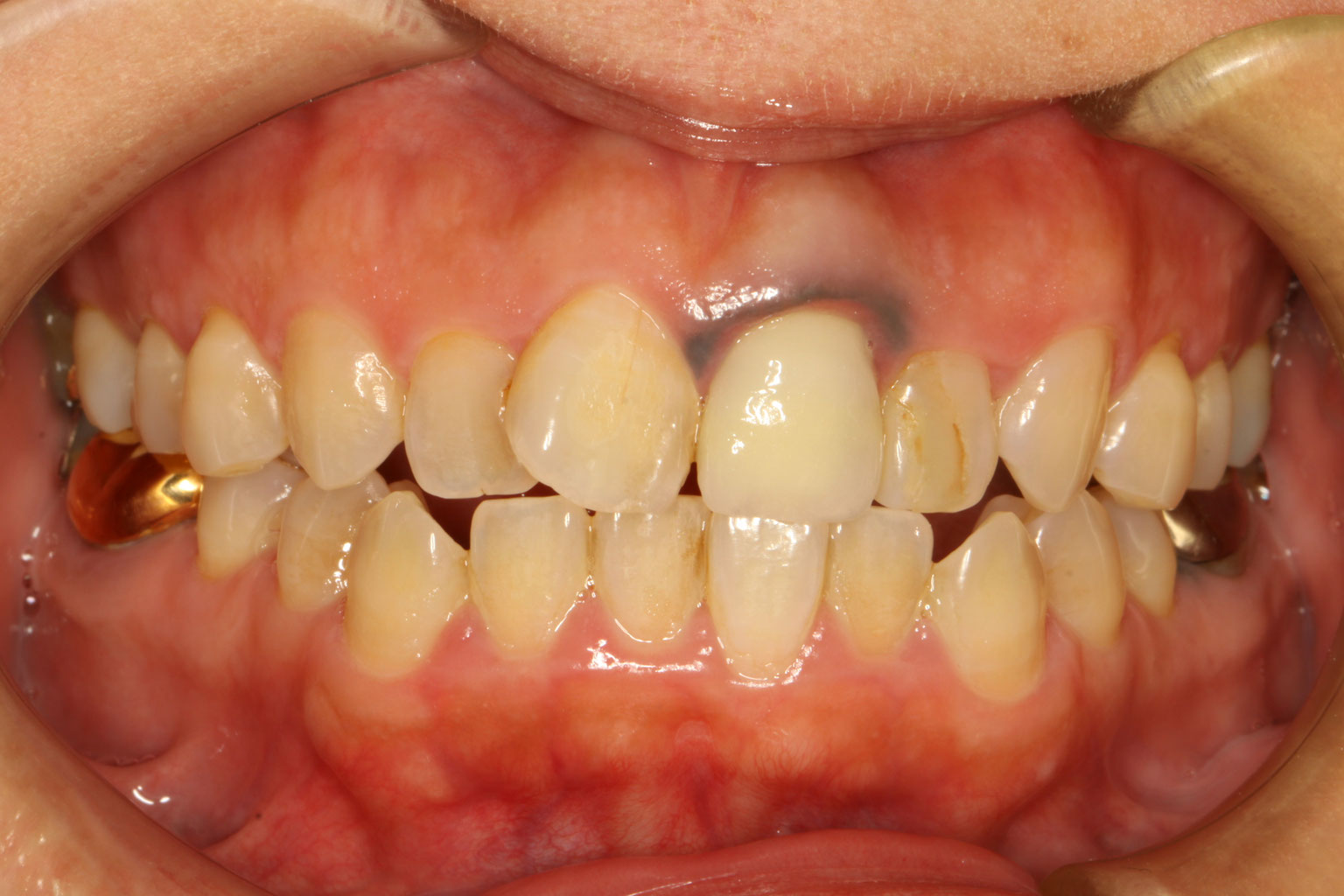 歯茎の黒ずみの原因はしっかりと歯茎を観察して頂ければ分かると思います。 審美歯科の専門ページ