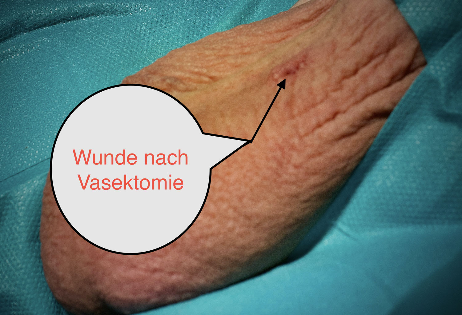 Leben Mikrowelle Teenager nach sterilisation samenerguss Beiseite Reproduzieren Vorverkauf Leben Mikrowelle Teenager nach sterilisation samenerguss Beiseite Reproduzieren Vorverkauf