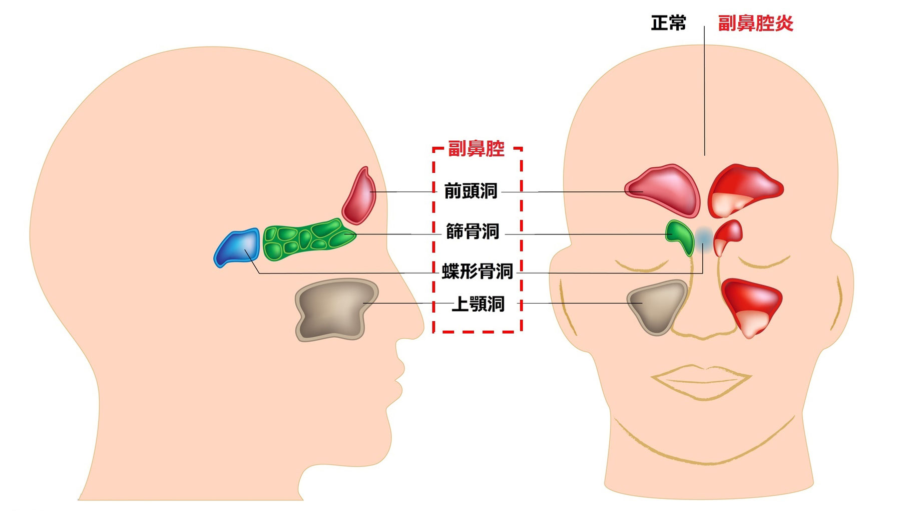 副鼻腔炎 茨木市の小児科 はら小児科クリニック 副鼻腔炎 茨木市の小児科 はら小児科クリニック