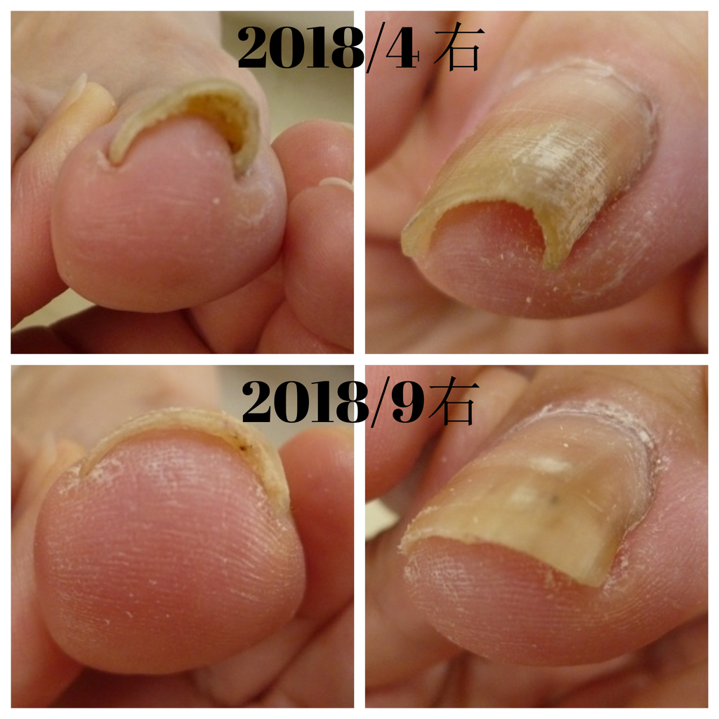巻き爪をキレイに広げる ペディグラス 大阪玉造のドイツ式フットケアサロン足愛 アシメ 巻き爪をキレイに広げる ペディグラス 大阪玉造のドイツ式フットケアサロン足愛 アシメ