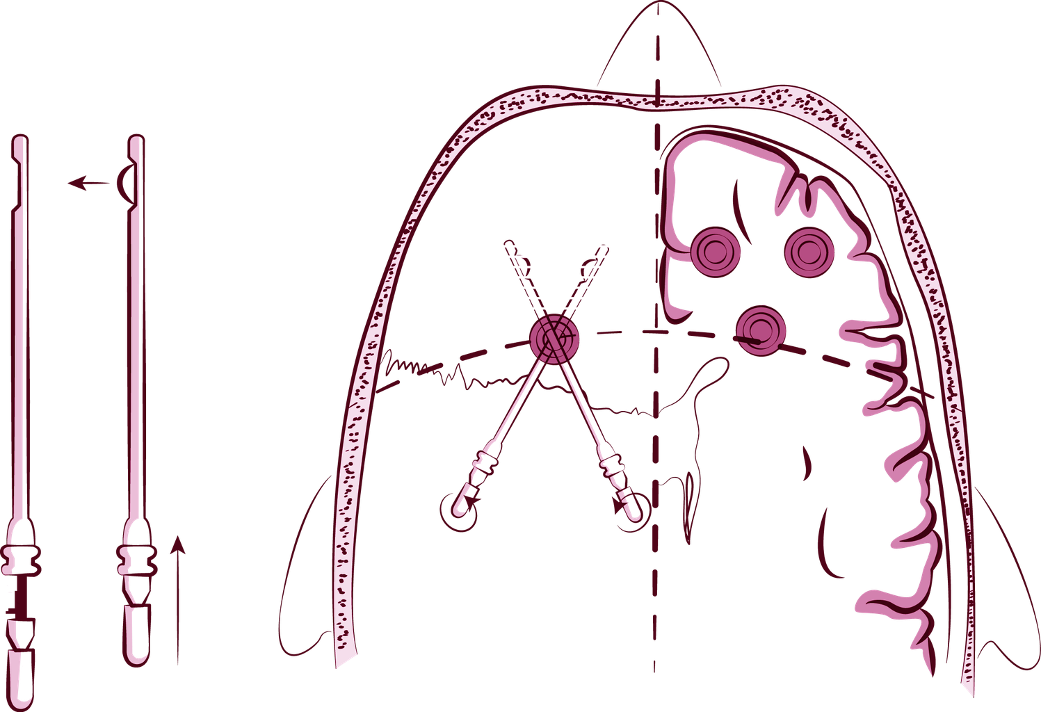 Psychochirurgie Histoire Lobotomie Neurochirurgien Marseille Aix En Provence But i was wondering when i get to max rep and can buy the lobotomizer would that be a. psychochirurgie histoire lobotomie