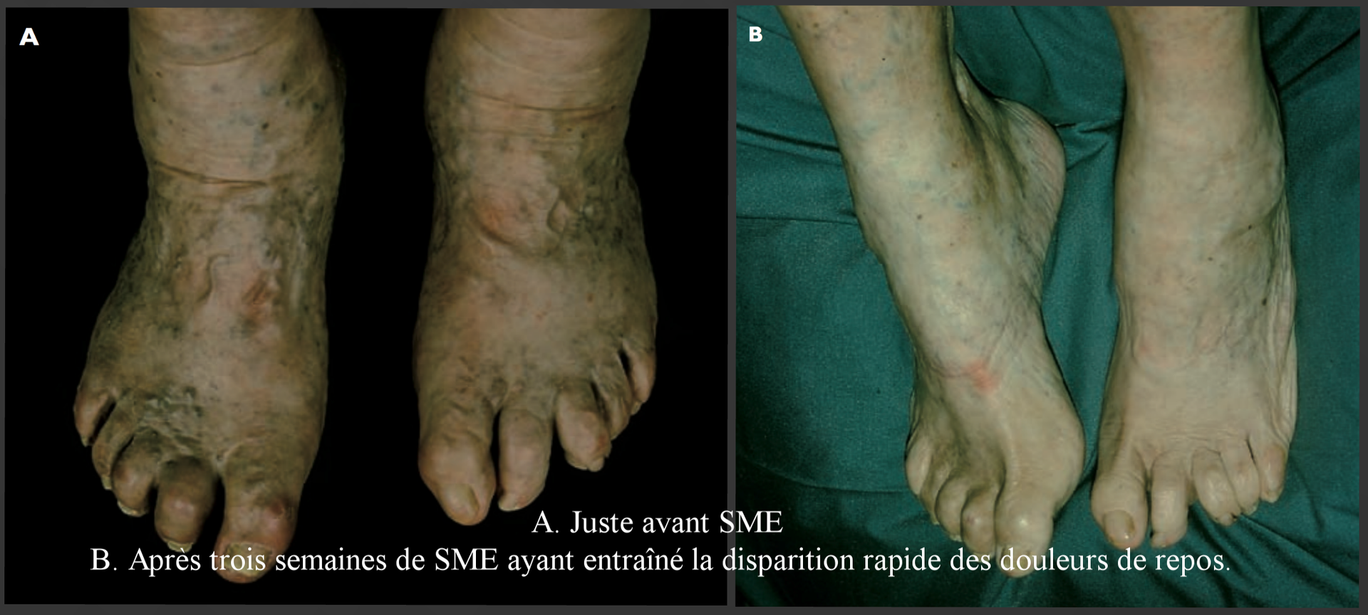 la stimulation médullaire dans le traitement des critical path format