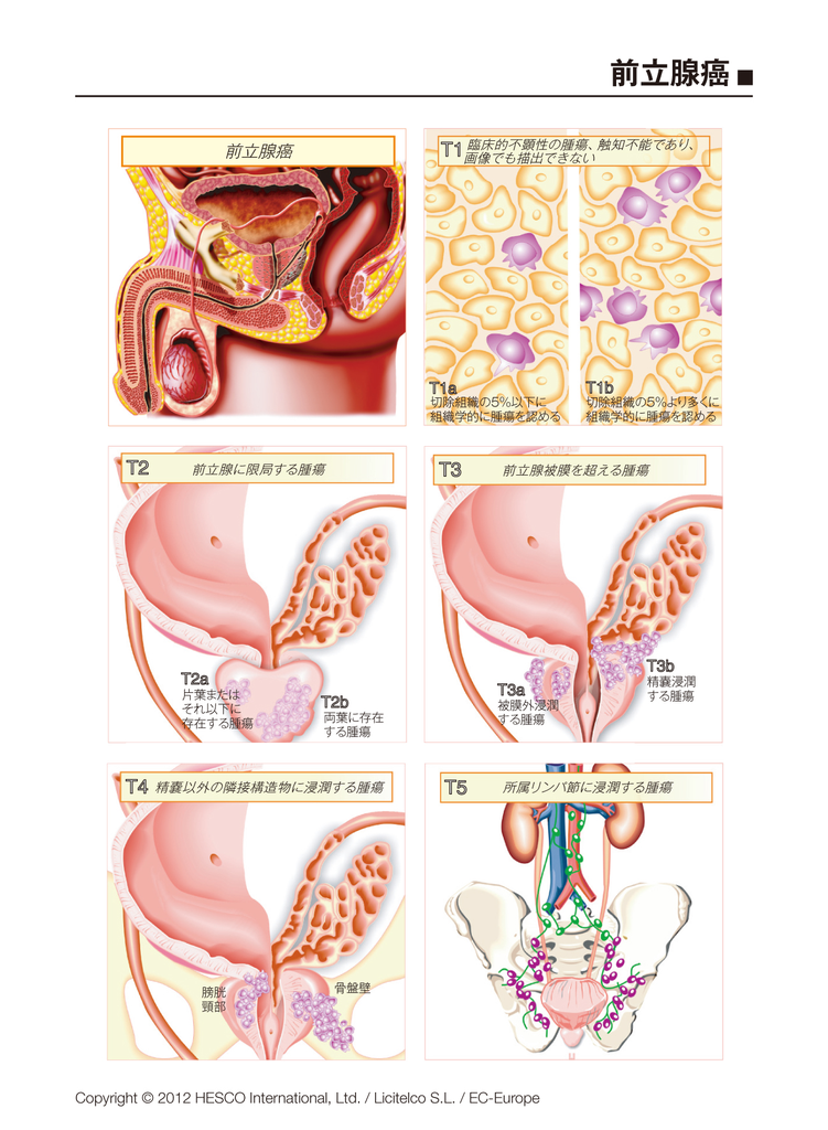 前立腺がんとpsa 船橋クリニック 千葉県泌尿器科 尿路結石症 腎結石 尿管結石 膀胱結石 に対するeswl 体外衝撃波結石破砕術 に特化したクリニックです