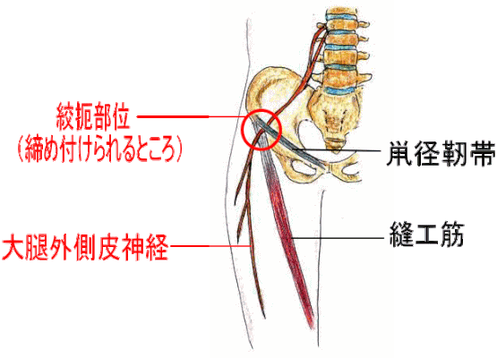 大腿外側皮神経の絞扼部位