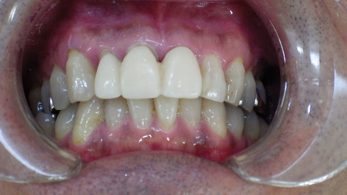 仮歯の状態