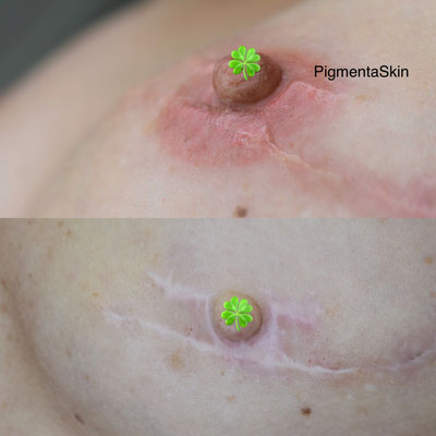 Medizinische Mikropigmentation Brust, Mamillenkomplex, Brustwarze, Brustwarzenhof