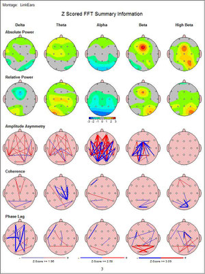 Verschiedene Teilauswertungen eines quantitativen EEGs. 19 Elektroden messen jedes einzelne Hertz der Hirnaktivität und dessen Abweichungen von einer gesunden Normpopulation.