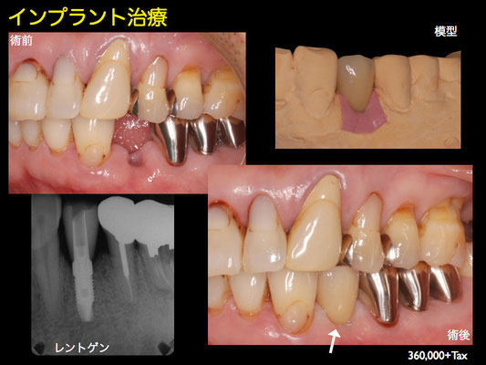 症例写真 インプラント 神栖市 東部歯科診療所 神栖市 歯医者