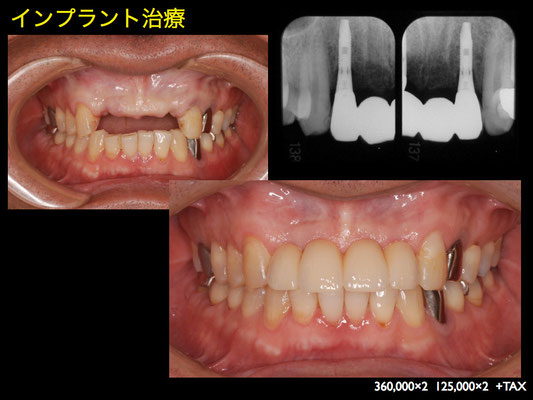 症例写真 インプラント 神栖市 東部歯科診療所 神栖市 歯医者
